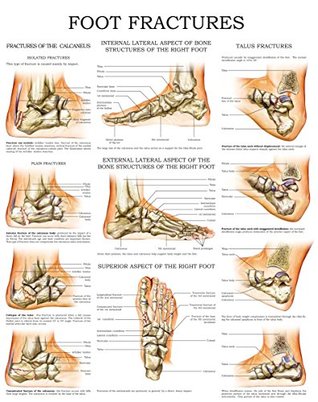 Read online Foot fractures - Quick Reference Chart: Full illustrated - HC-HealthComm | ePub